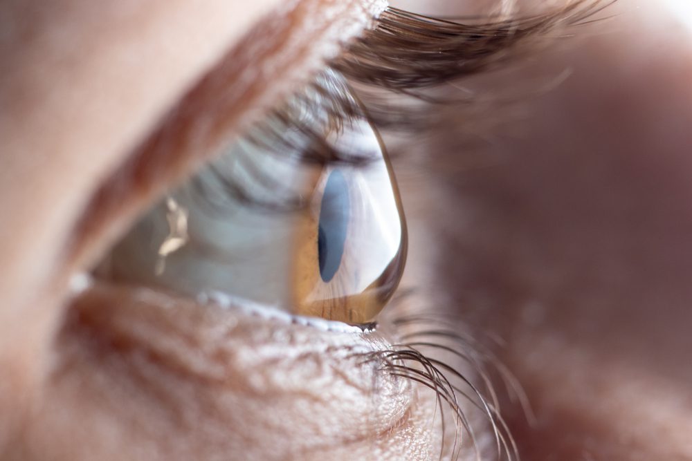 Eye with astigmatism