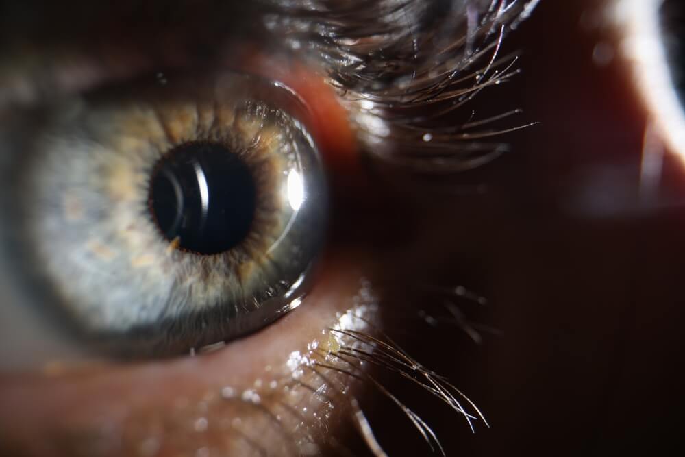 Lasik Consultations Elk River