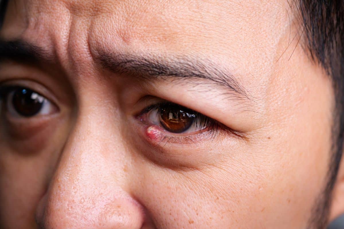 Eye Infection Treatment at Home vs. Clinical Care: Which Works Best?