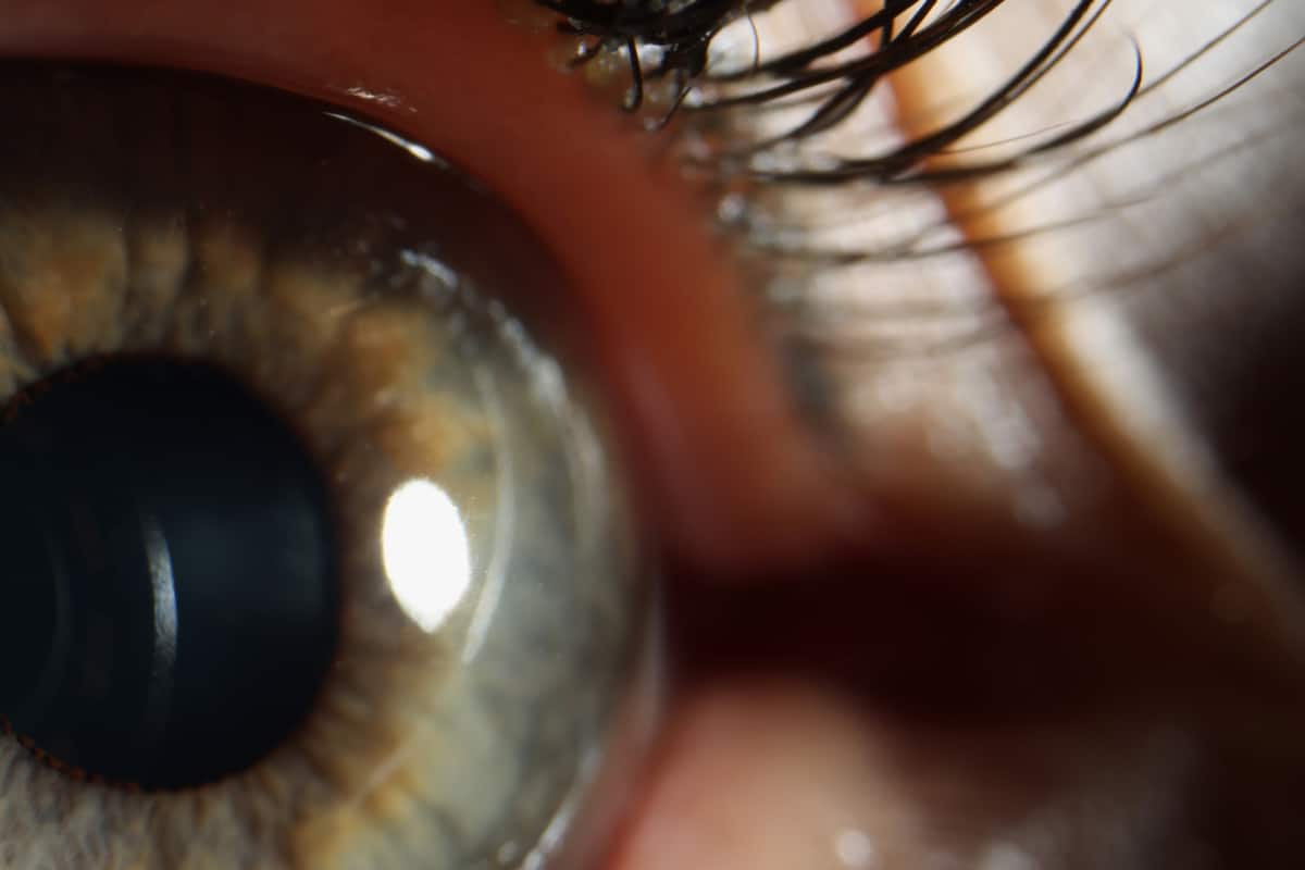 Pink Eye Season Is Here: Causes, Spread, and Treatment
