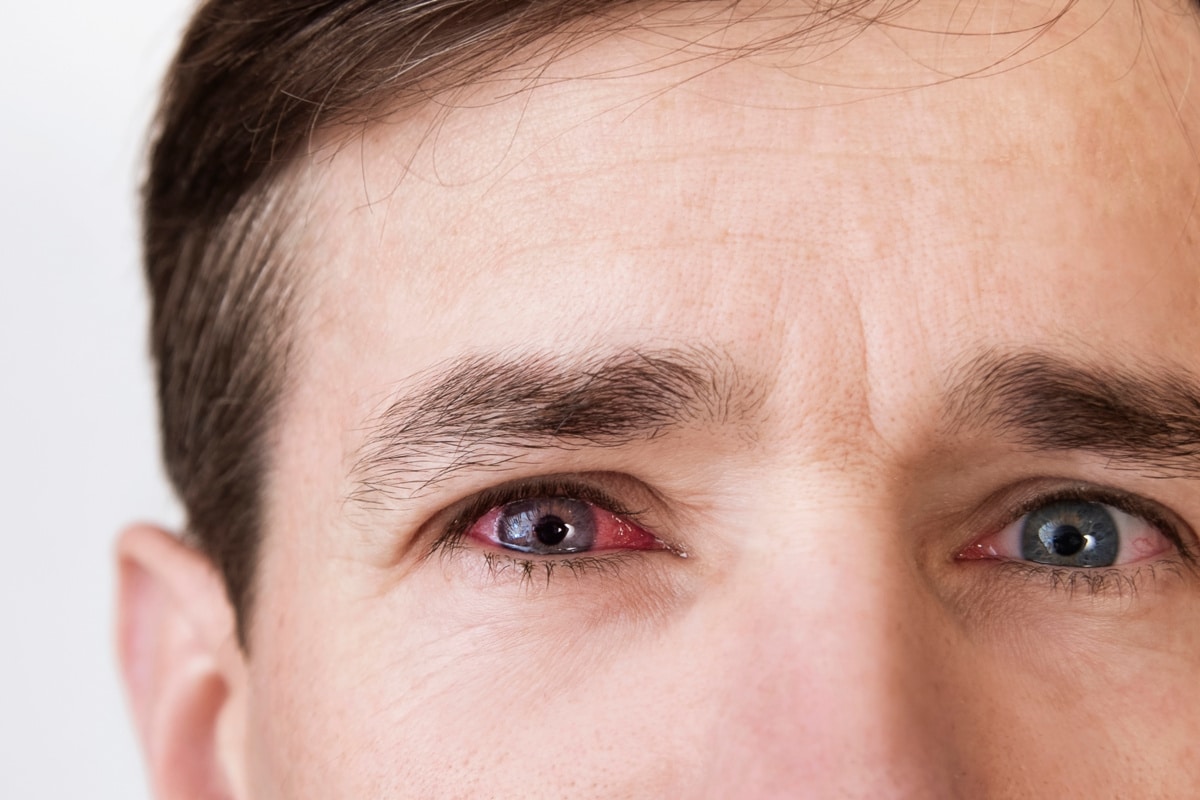 Pink Eye Season Is Here: Causes, Spread, and Treatment